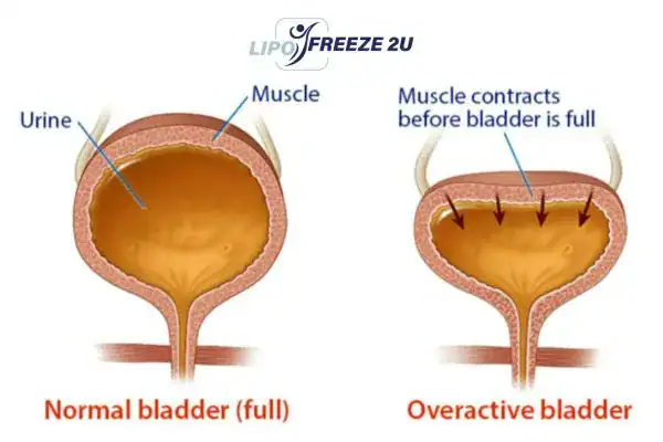 diagram of overactive bladder treatment Leicester