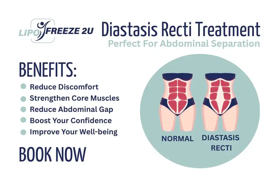 How Long Will It Take to See Improvements in Diastasis Recti Leicester