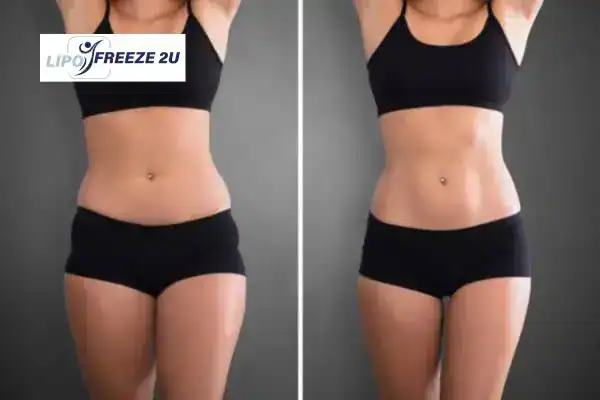 How Can LIPO FREEZE 2U Support Your Post-Pregnancy Body Recovery Leicester?