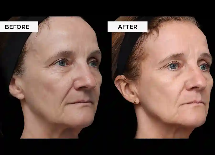 How Many RF Microneedling Sessions Will You Need to See a Difference Leicester?