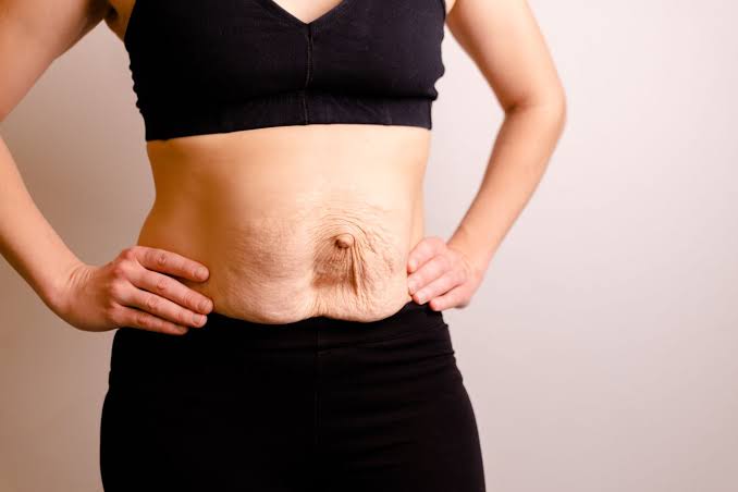 Is Surgery Really the Only Way to Repair Diastasis Recti Leicester?