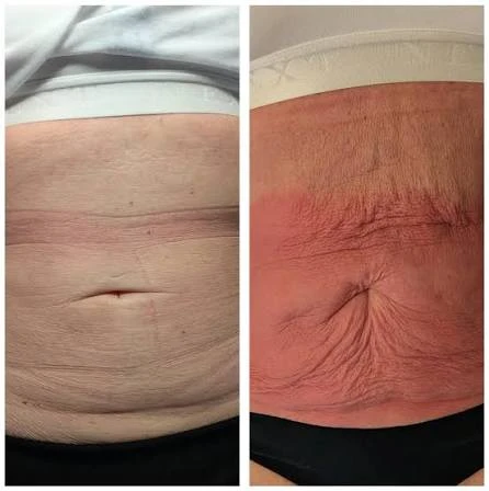 How Does RF Microneedling Improve Crepey, Thin and Uneven Skin Texture Leicester?