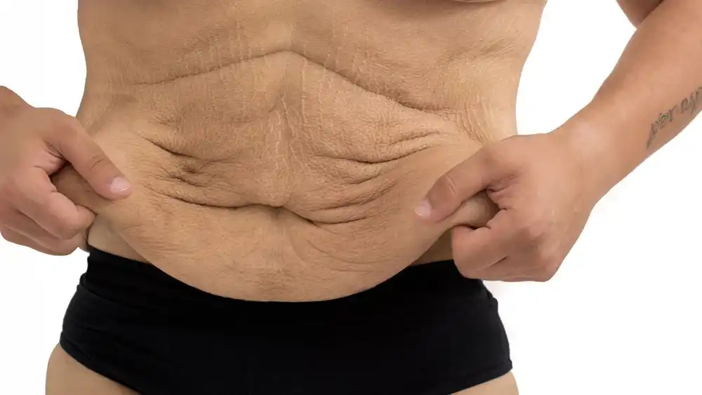 Why Does Weight Loss Medication Leave Some People With Loose or Sagging Skin Leicester?